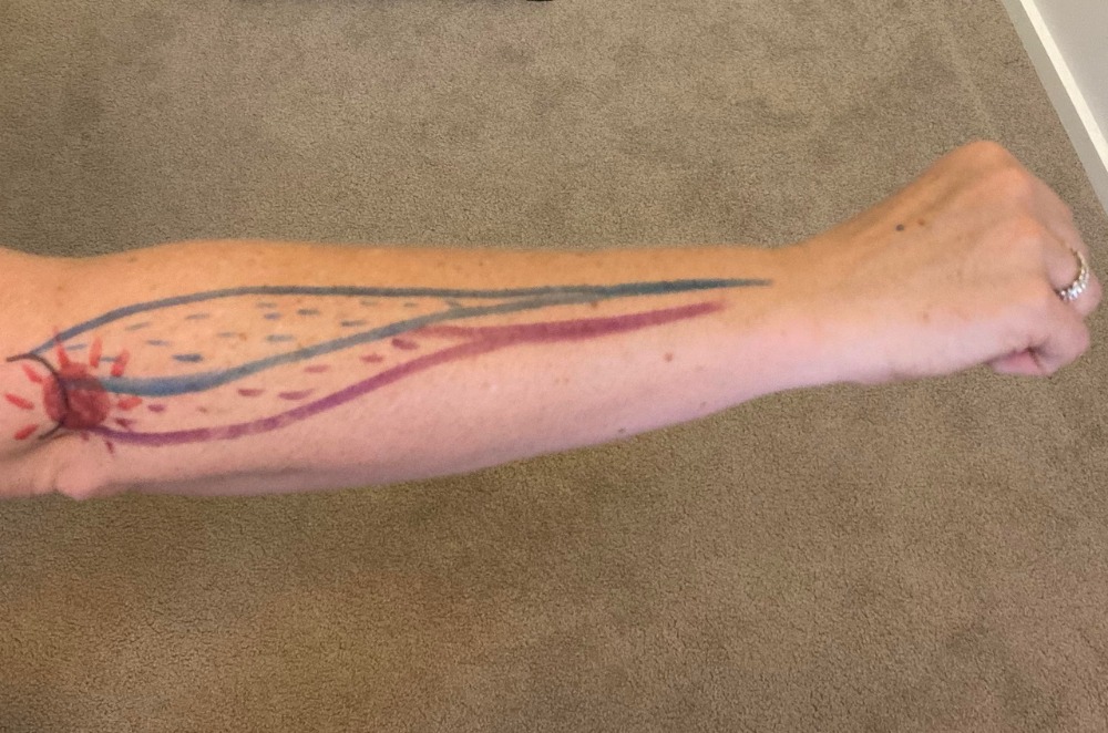 Pain location in Tennis Elbow